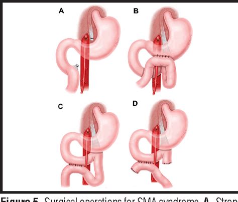 Superior Mesenteric Artery Syndrome | Semantic Scholar