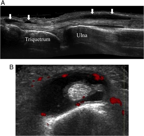 Extensor Tendon Ultrasound