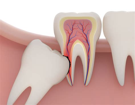 Wisdom Tooth Extractions San Diego - Dentist in San Diego