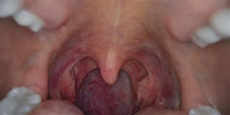 Tonsil cancer- symptoms, causes and treatment - Medically Speaking