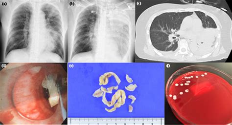 Corynebacterium ulcerans pneumonia treated with venovenous ...