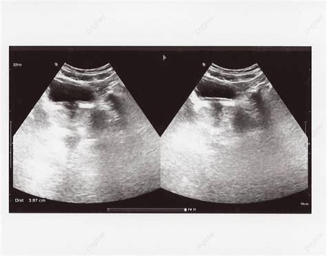 Full Abdomen Ultrasound Sonogram Sonogram Echography Cure Photo Background And Picture For Free ...