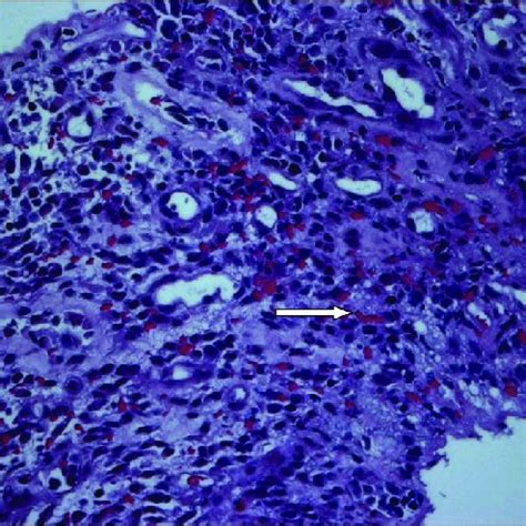 Histology of the "colon cast" showing necrotic fibrinopurulent exudate ...