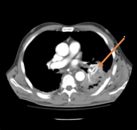 Chest Tube Complications and How to Fix Them - County EM - Trauma