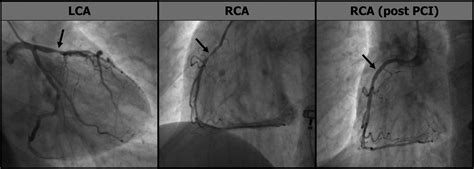 Exercise-Induced Spastic Coronary Artery Occlusion at the Site of a ...