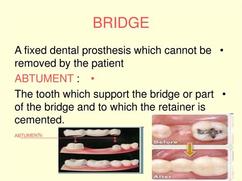 PPT - PONTIC DESIGN By DR. MUSTAFA I. ELGHOUL B.SC,B.D.S,MS(ORTHO) PowerPoint Presentation - ID ...