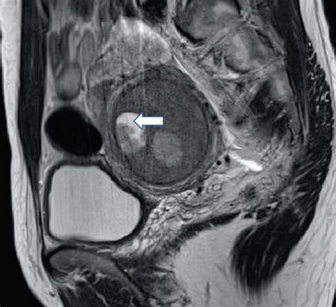 Unenhanced pelvic MRI. (a) Sagittal T1-WI shows a tumor demonstrating ...