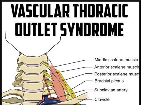 Cervical Rib Removal Surgery for Thoracic Outlet Syndrome - Givealittle