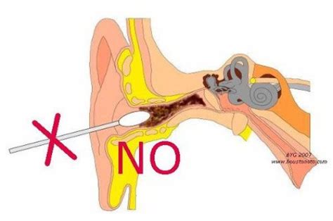 How To Get Rid Of Earwax Buildup Without Damaging Your Ears