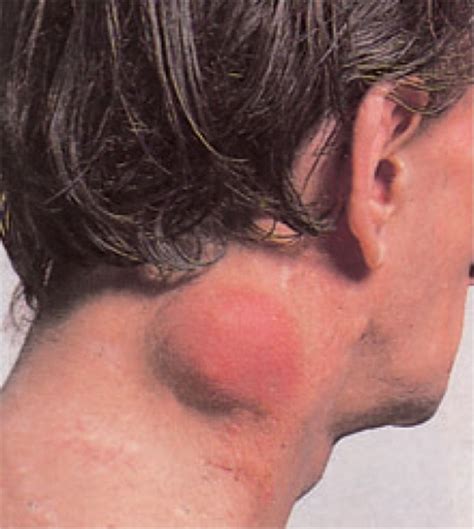 Lymphoma In Neck | Non hodgkins lymphoma, Non hodgkins lymphoma ...