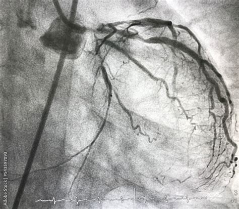 Coronary angiography shown left main (LM) stenosis with triple vessel disease (TVD). Stock Photo ...