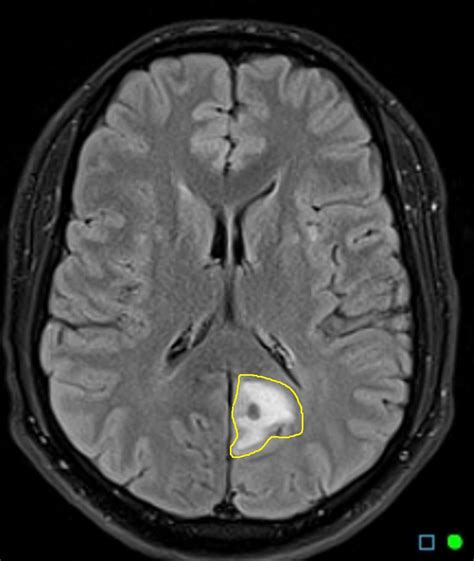 Cysticercosis MRI - wikidoc