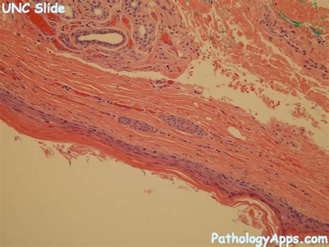 dermoid cyst pathology