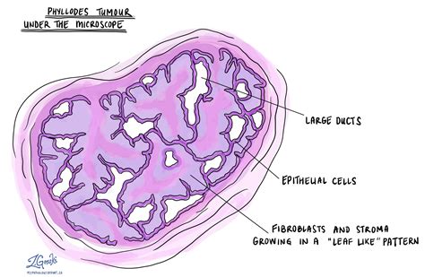 Phyllodes tumour (breast) - MyPathologyReport.ca