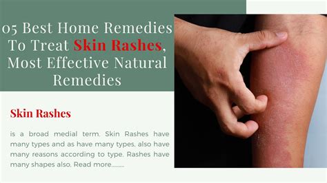 05 Best Home Remedies To Treat Skin Rashes, Most Effective Natural Remedies