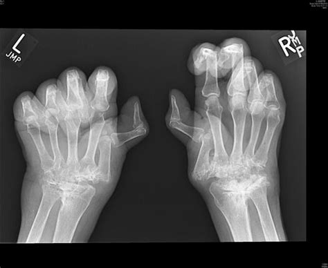 Palindromic rheumatism - WikiProjectMed