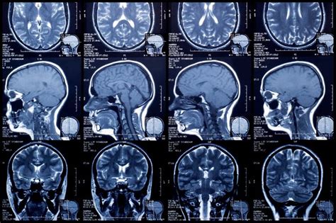 Single MRI scan promises to diagnose early- and late-stage Alzheimer’s | Mri scan, Mri, Brain scan