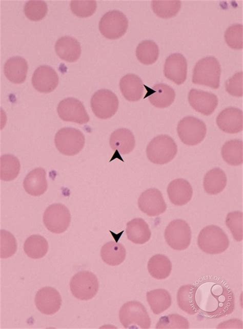 Howell Jolly Bodies in chronic graft vs host disease