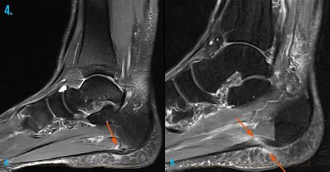 MRI Scan for Ankle Injury Melbourne - Melbourne Radiology