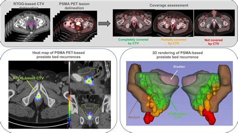 68Ga-PSMA PET/CT–Based Atlas for Prostate Bed Recurrence After Radical ...