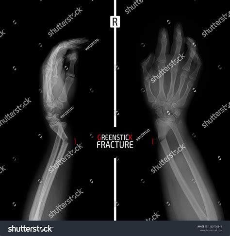 Greenstick Fracture Treatment