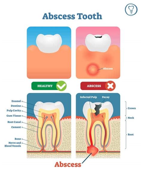 Have a Tooth Infection? See Your Dentist – Gjbrq