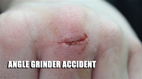 Angle Grinder Accident - YouTube