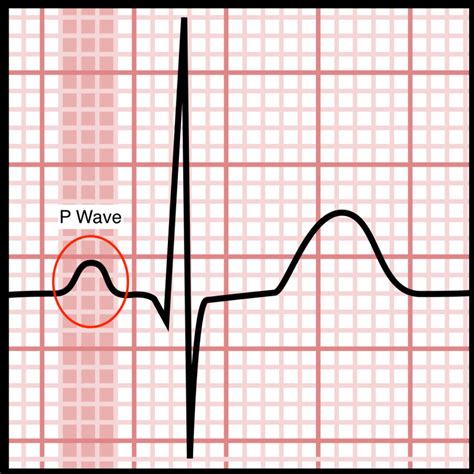 Electrocardiograms (EKGs/ECGs): Evaluating P Waves - Stepwards