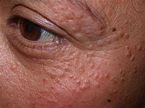 Syringoma - Causes and Treatment | Cosmetics M.D.