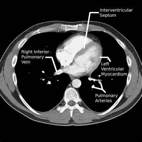 Ct Chest Anatomy - Anatomical Charts & Posters