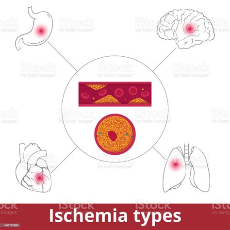 Ischemia Types Stock Illustration - Download Image Now - Anatomy, Arteriosclerosis, Artery - iStock