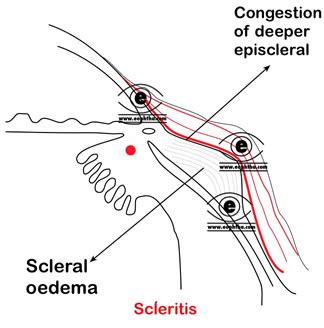 Episclera