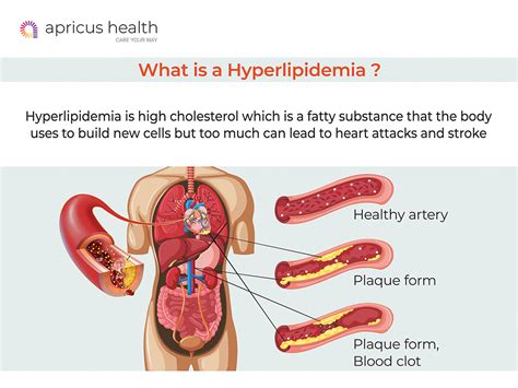 Hyperlipidemia Or High Cholesterol: Causes, Diagnosis And Treatment ...