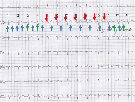 ECG Rhythms: Atrial tachycardia with a block vs. AFl with Wenckebach