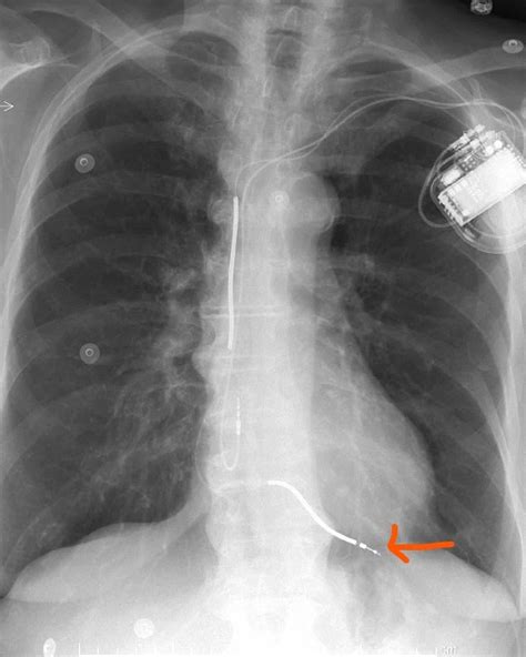 Unusual Delayed Complication of Pacemaker Leads | Cureus