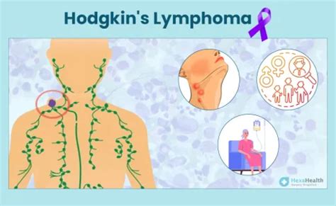 Hodgkin's Lymphoma: Symptoms, Causes, Stages, Treatment