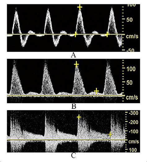 Spectral Doppler waveforms demonstrate laminar (A), disturbed (B), and... | Download Scientific ...