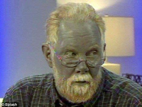 Man turns BLUE after he self-medicates for a skin condition | Skin conditions, Skin, Antibiotics ...