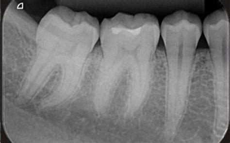 Oral Radiology - Common Types Of Intraoral Radiograph | GetDoc Says