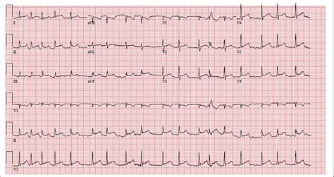 A Rare Presentation of Nocardia pericarditis Leading to Cardiac ...