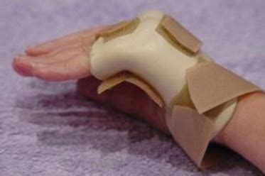 Metacarpal fracture – Hand Therapy Group