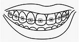 Coloring Pages Kids With Braces sketch template