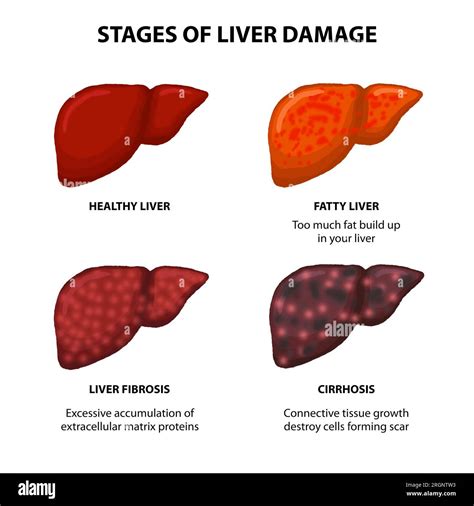 Liver Cirrhosis Stages