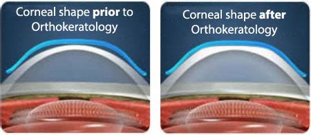 Are Ortho K Contacts For You? - Contacts Advice