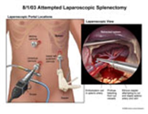 AMICUS Illustration of amicus,injury,surgery,splenic,artery,laparoscopic,splenectomy,stapler ...