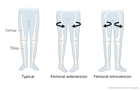 Femoral Anteversion Angle