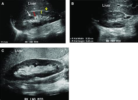 Normal Kidney Ultrasound