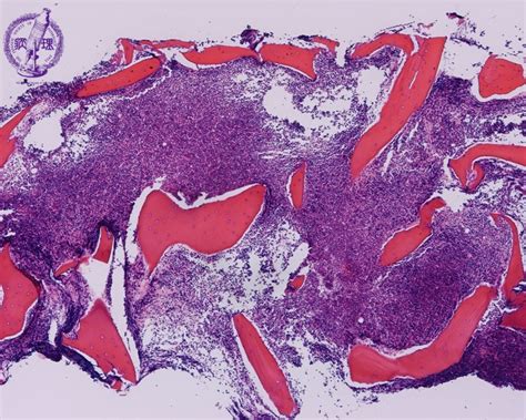 1.Bone marrow / Hematopoietic system (7) Acute lymphoblastic leukemia ...