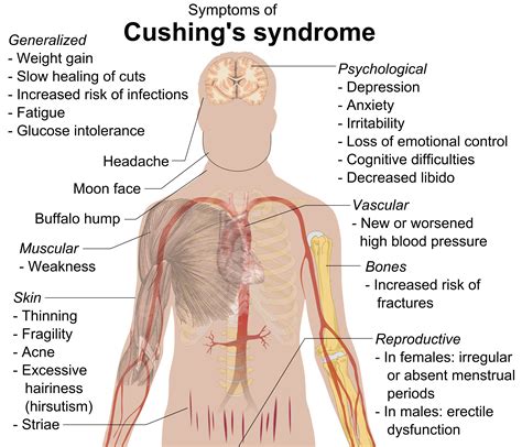 Cushing's Syndrome - almostadoctor