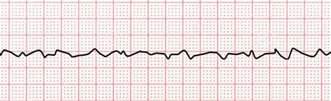 The Difference Between Ventricular Tachycardia and Ventricular ...